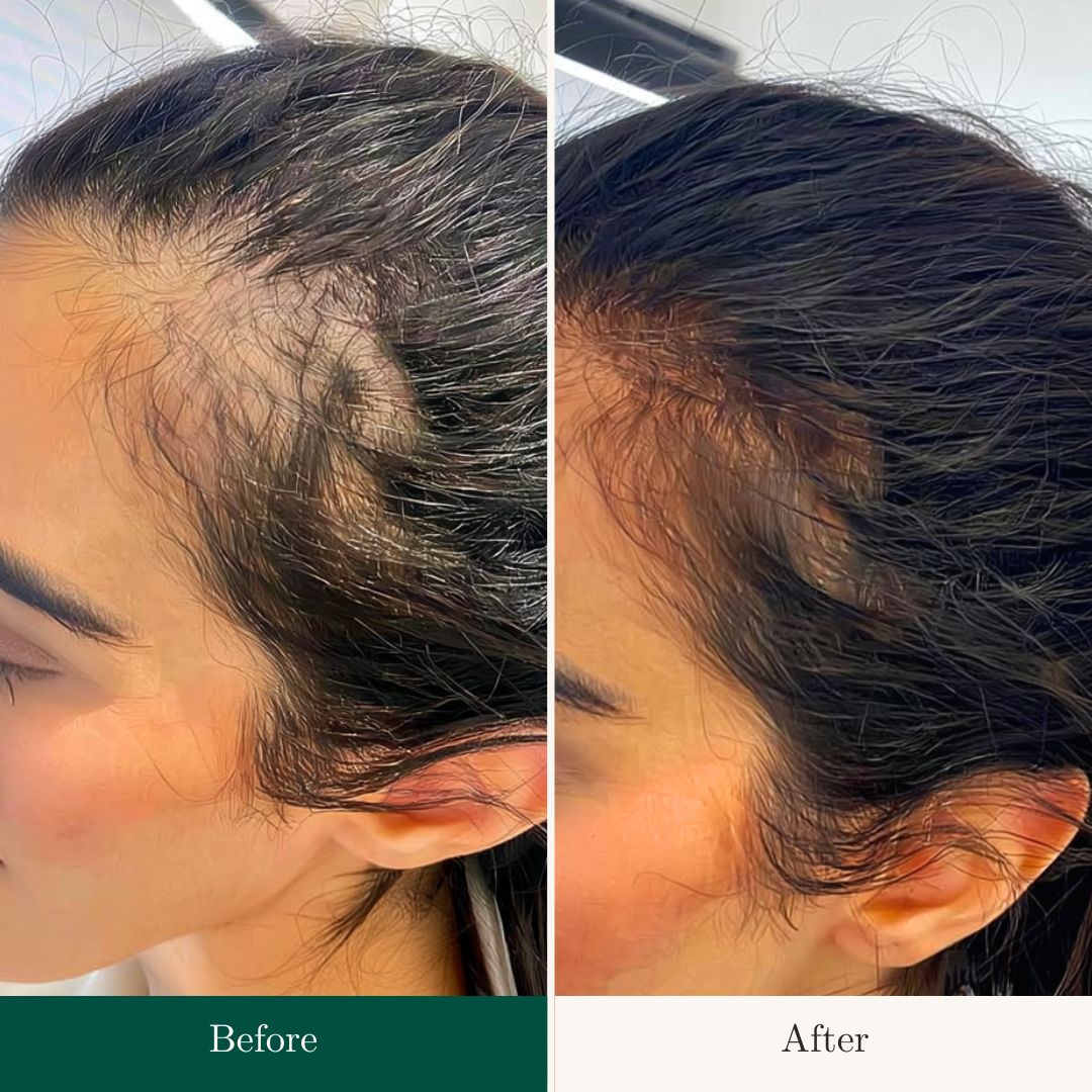 Before After 25